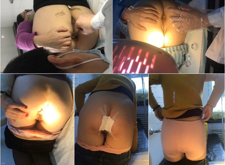 Medical Procedures for Hemorrhoids 2
